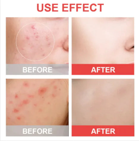 ACNE COVER PATCH