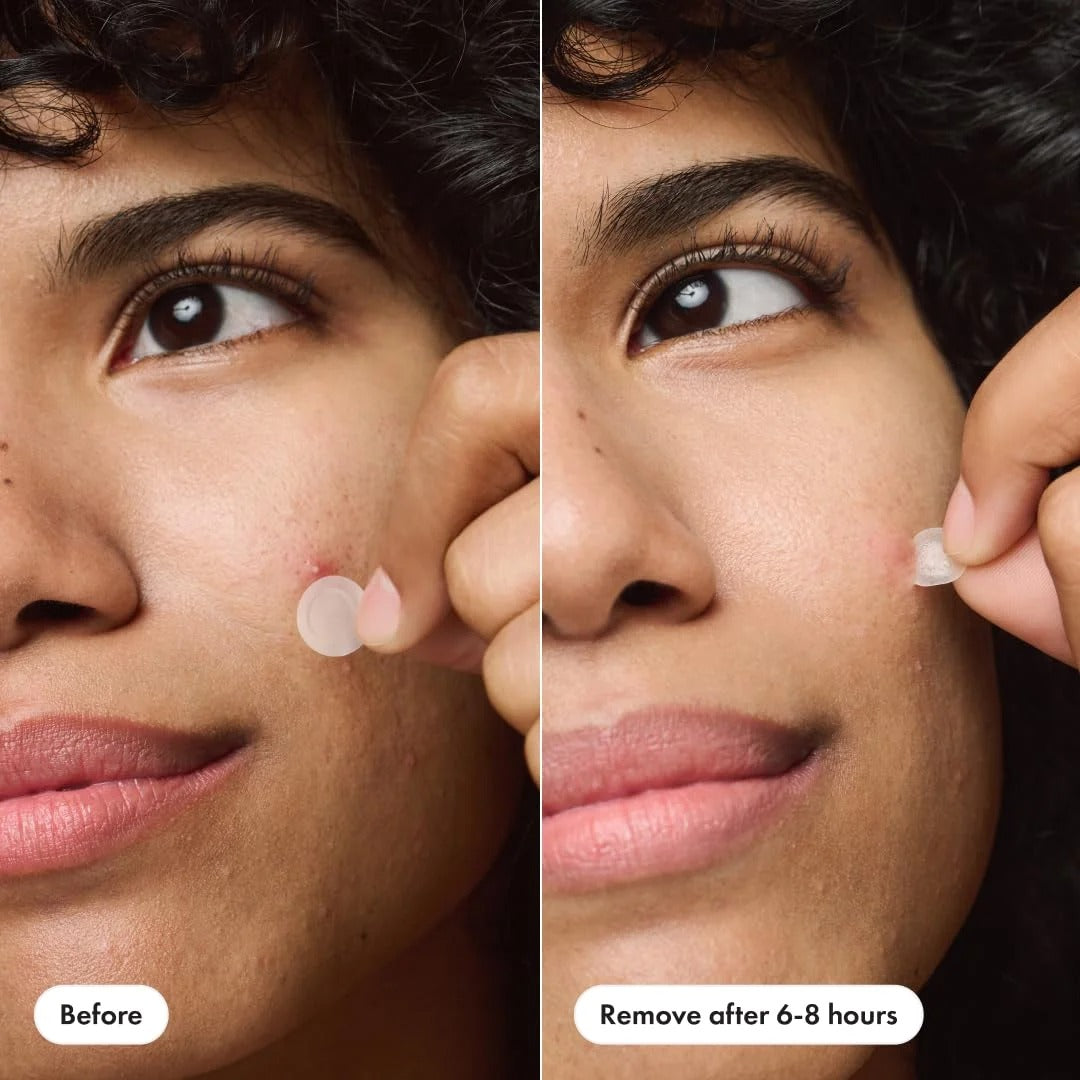 ACNE COVER PATCH